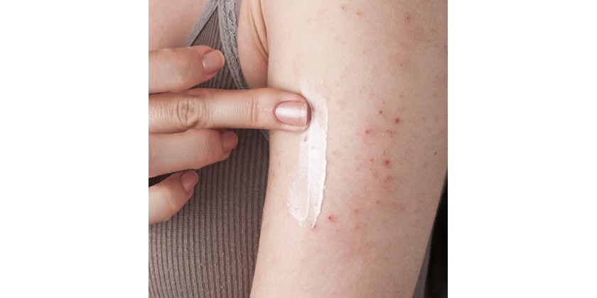 Dermatitis Atópica: cómo tratarla